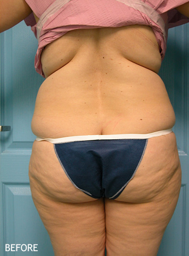 SmartLipo--x2122--Patient-16 | Before SmartLipo™