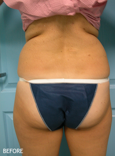 SmartLipo--x2122--Patient-17 | Before SmartLipo™