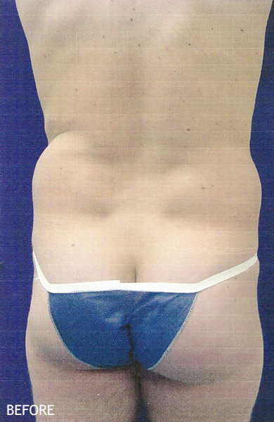 SmartLipo--x2122--Patient-18 | Before SmartLipo™